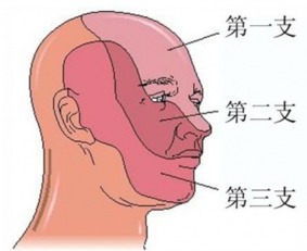 治疗三叉神经痛的最新方法是什么