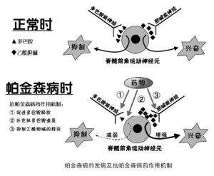 帕金森综合症早期表现有什么?